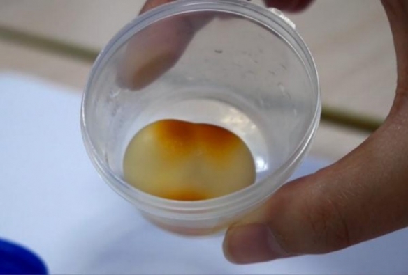 酷似“和田羊脂玉”的胆结石！网友：火化必出舍利子！