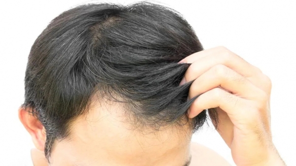 不用再担心脱发了！科学家发现刺激头发生长分子
