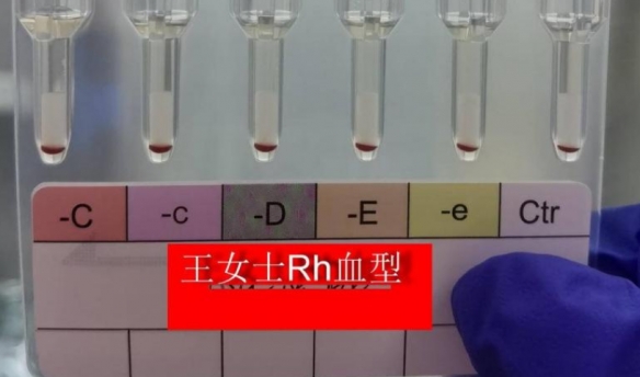 全球不足50例国内报道仅4例！江苏现2例罕见黄金血型